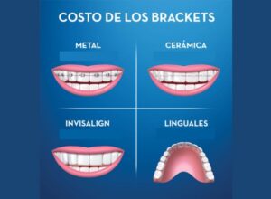 Cu Nto Cuesta Un Tratamiento De Ortodoncia Dentas Tool