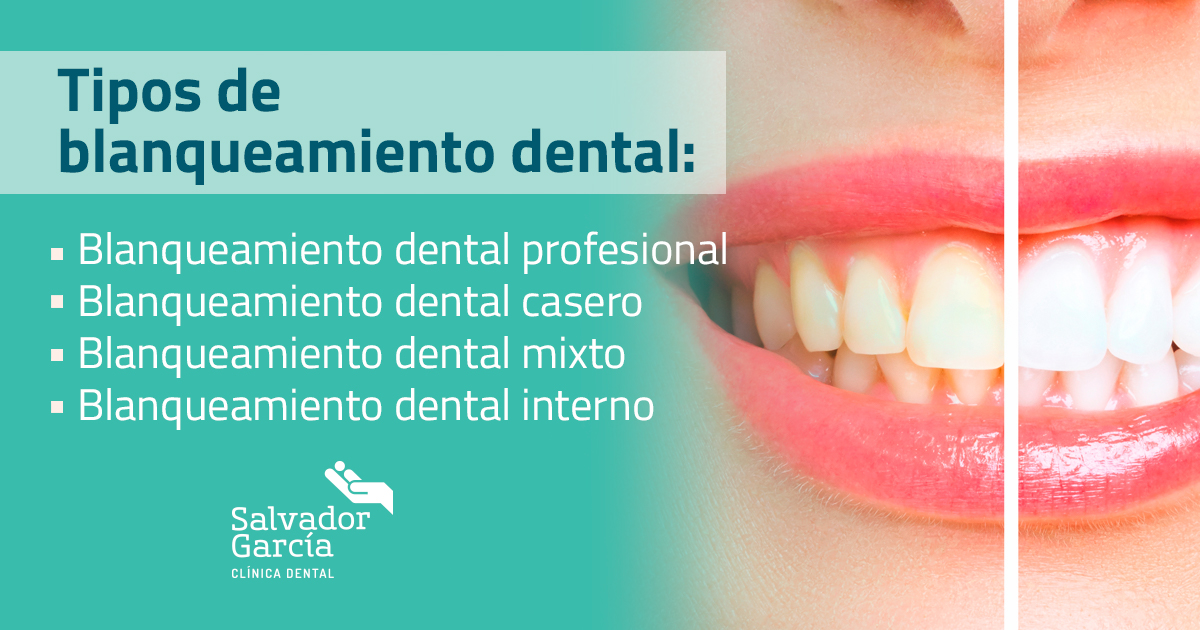 ¿Cómo Es Un Blanqueamiento Dental? – Dentas Tool