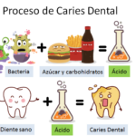 como se origina la caries dental