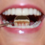 tipos de retenedores ortodoncia