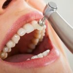 cuanto cuesta una limpieza dental y blanqueamiento