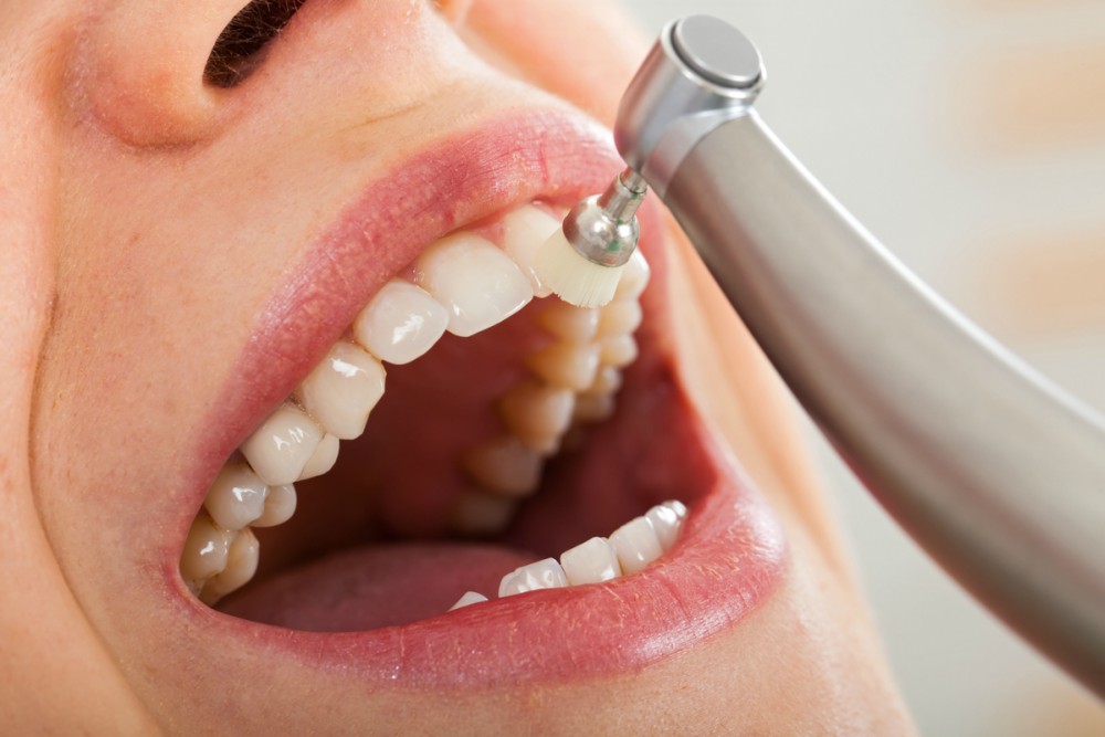 cuanto cuesta una limpieza dental y blanqueamiento