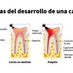 que ocasiona la caries dental