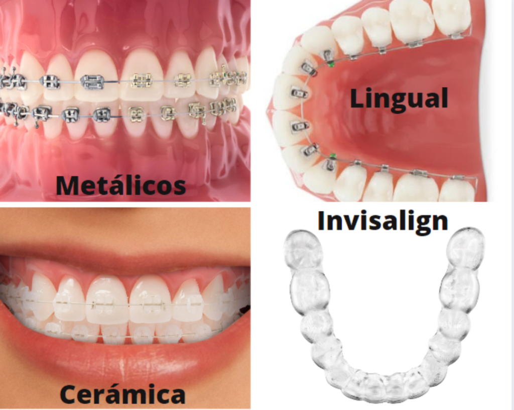 que es una ortodoncia dental y cuanto cuesta