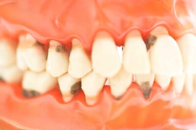 ¿Qué hacer para prevenir enfermedades de las encías? – Dentas Tool