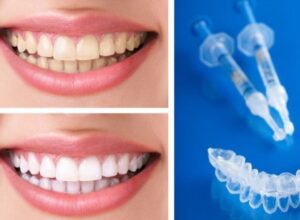 ¿Cómo Se Hace Un Blanqueamiento Dental Eficaz Y Seguro? – Dentas Tool