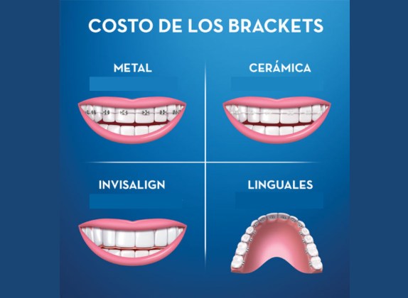 cuanto cuesta un tratamiento de ortodoncia