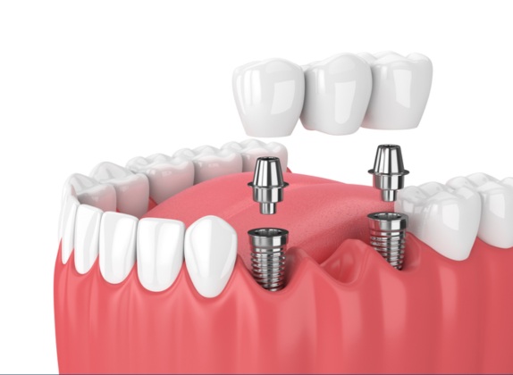 donde hacen implantes dentales gratis