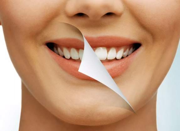 ventajas y desventajas del blanqueamiento dental